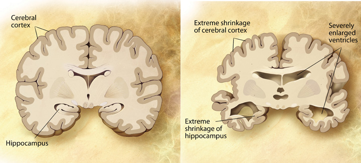 These diagrams illustrates a healthy human brain on the left and, on the right, a brain with Alzheimer’s where the cerebral cortex and the hippocampus have reduced in size and ventricles have enlarged.