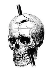This diagram shows a metal rod through a human skull.