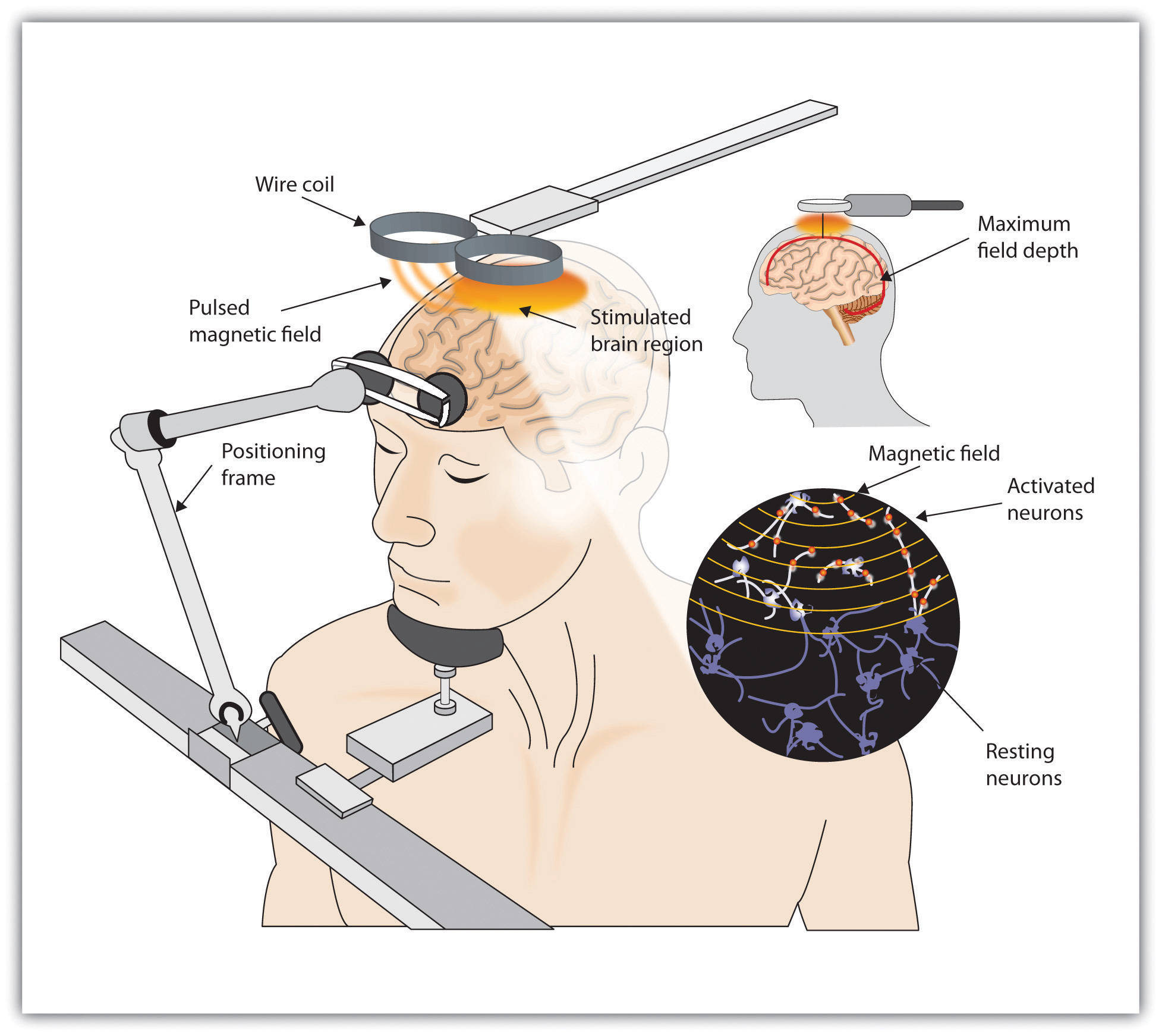 This diagram illustrates a man receiving transcranial magnetic stimulation (TMS) in which two wire coils pulse a magnetic field to electrically stimulate his brain.