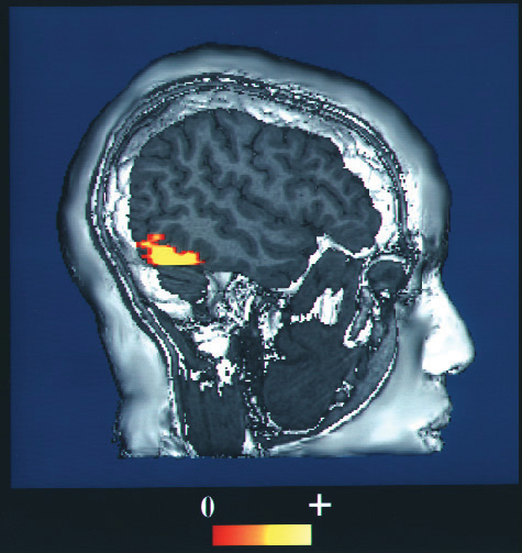 This functional magnetic resonance image (fMRI) shows a human brain with an area of increased activity.