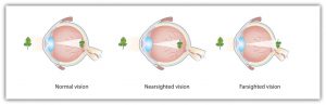 This diagram shows how normal vision, nearsighted vision, and farsighted vision focus incoming light on the retina.