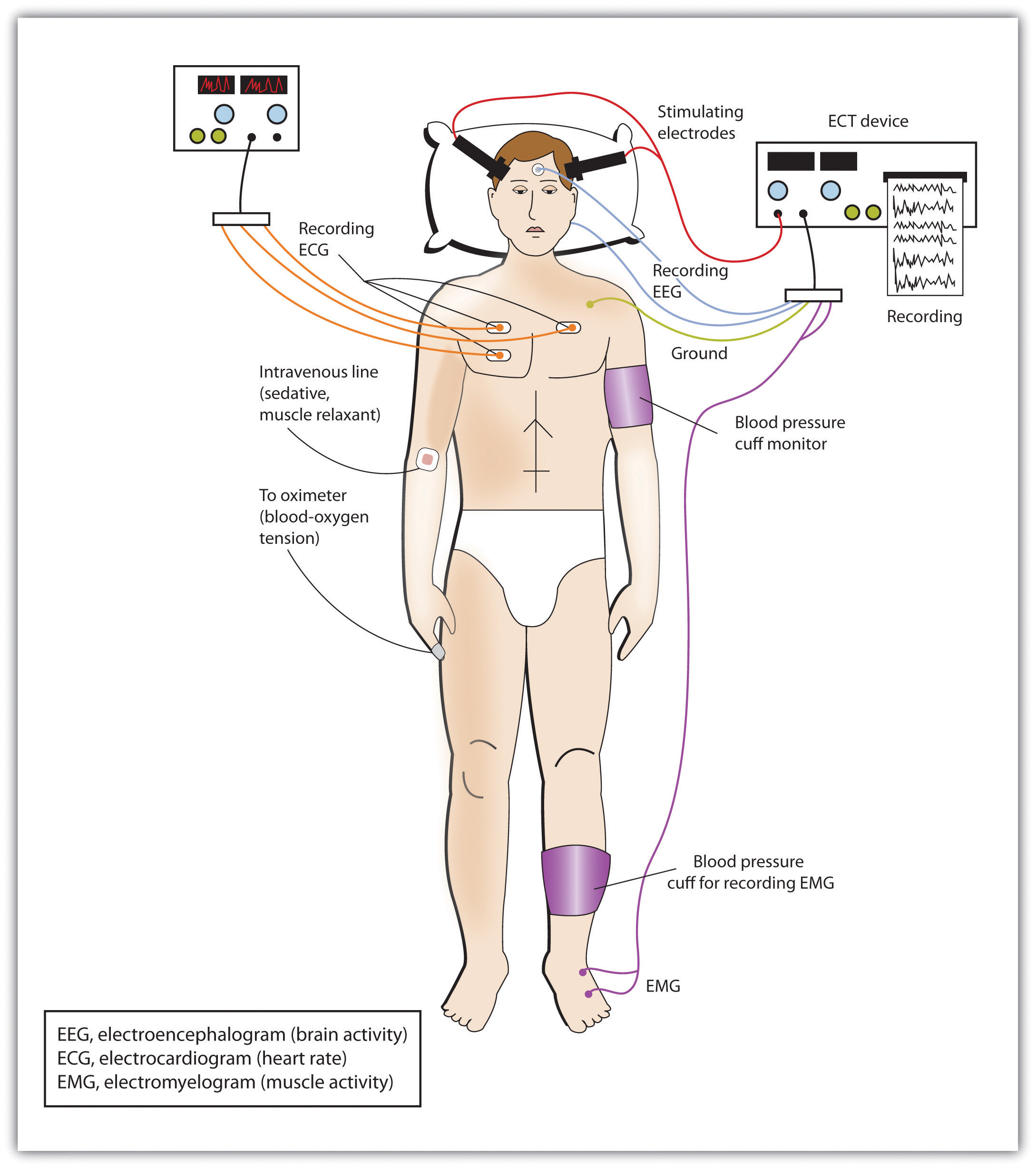 This diagram illustrates a man receiving electroconvulsive therapy (ECT) in which various wires and electrodes are shown to be hooked up to his body and nearby machines.