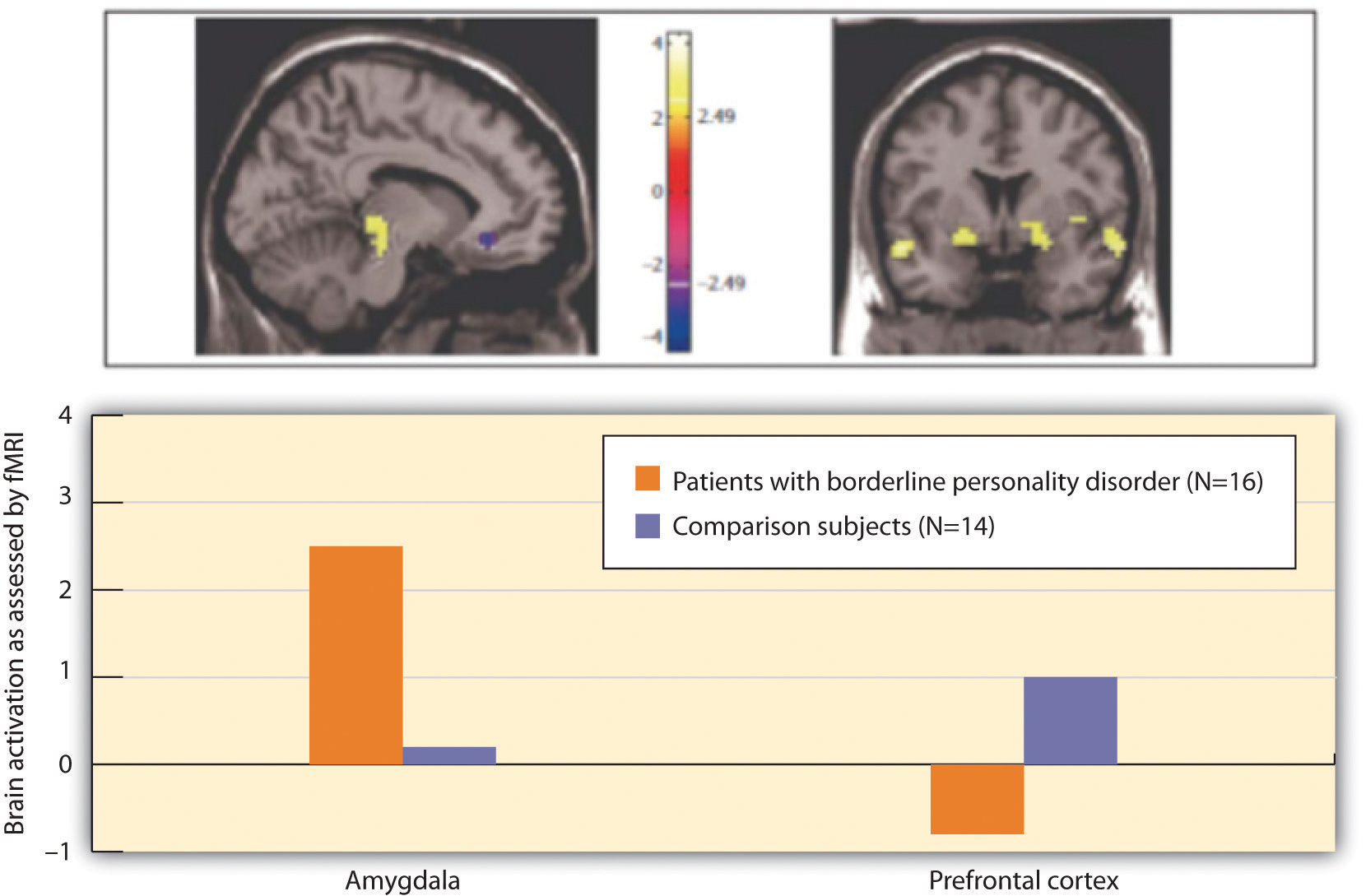 Above, these pictures show two brain scans comparing the level of brain activity in the emotional centres in the amygdala (left) and the prefrontal cortex (right); below, this chart contrasts brain activation as assessed by fMRI by amygdala and prefrontal cortex in patients with borderline personality disorder and comparison subjects.