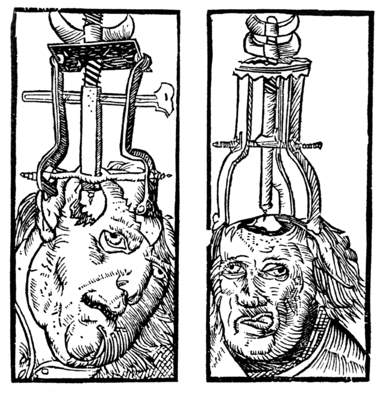 This diagram illustrates an engraving by Peter Treveris of a trepanation. A type of drill is clamped onto the head and used to bore a hole through the skull and expose the dura matter.